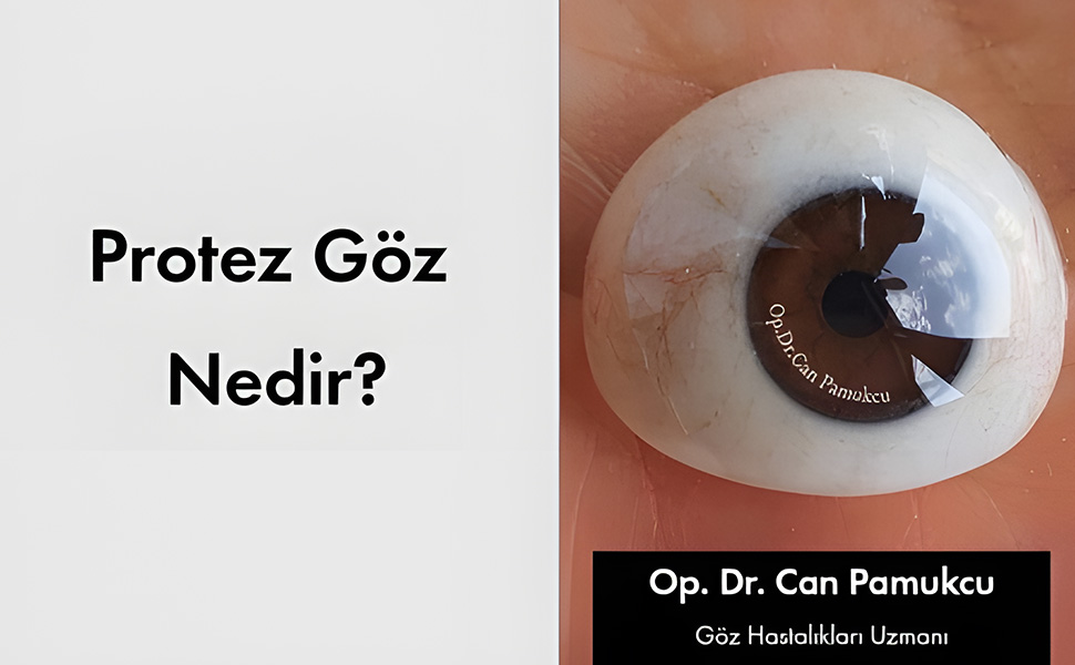 Protez Göz Nedir?